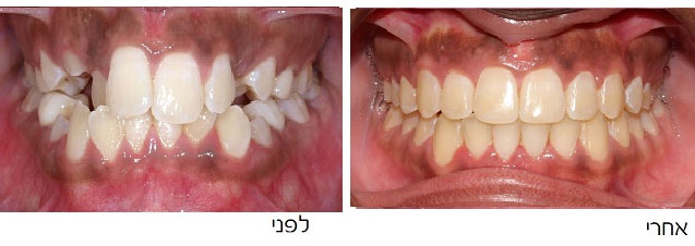 שיניים עקומות