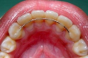 דוגמה לקיבוע קבוע המודבק לשיניים